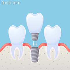 Dental Implant consult 대표사진