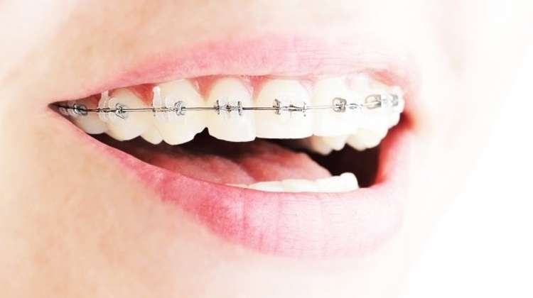 치아교정 대표사진