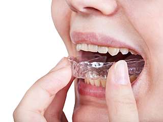 치아교정(투명교정, 인비절라인) 대표사진