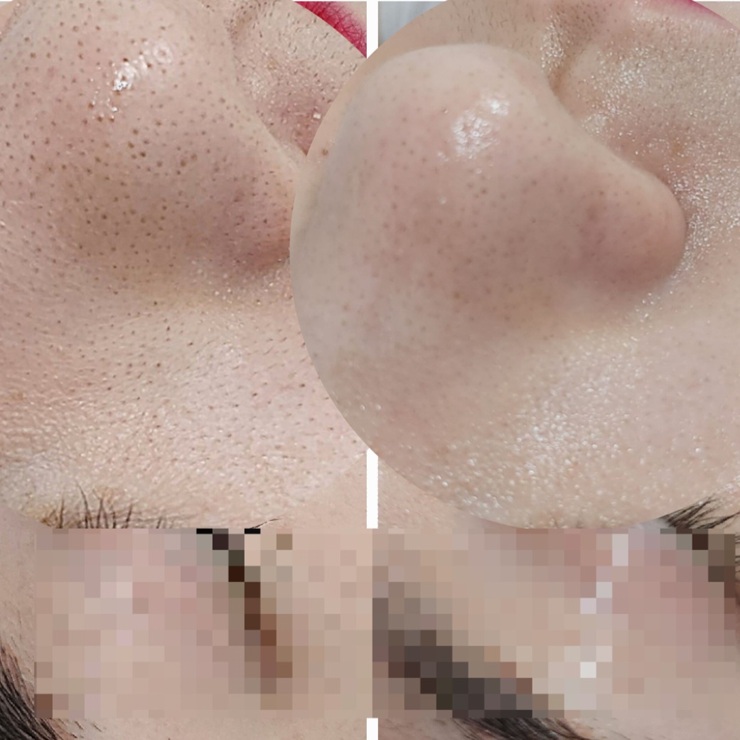 정원장의 모공세척테라피