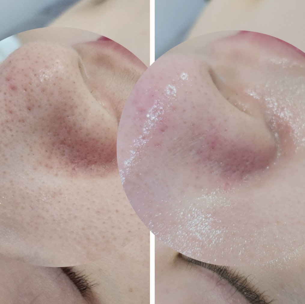 정원장의 모공세척테라피