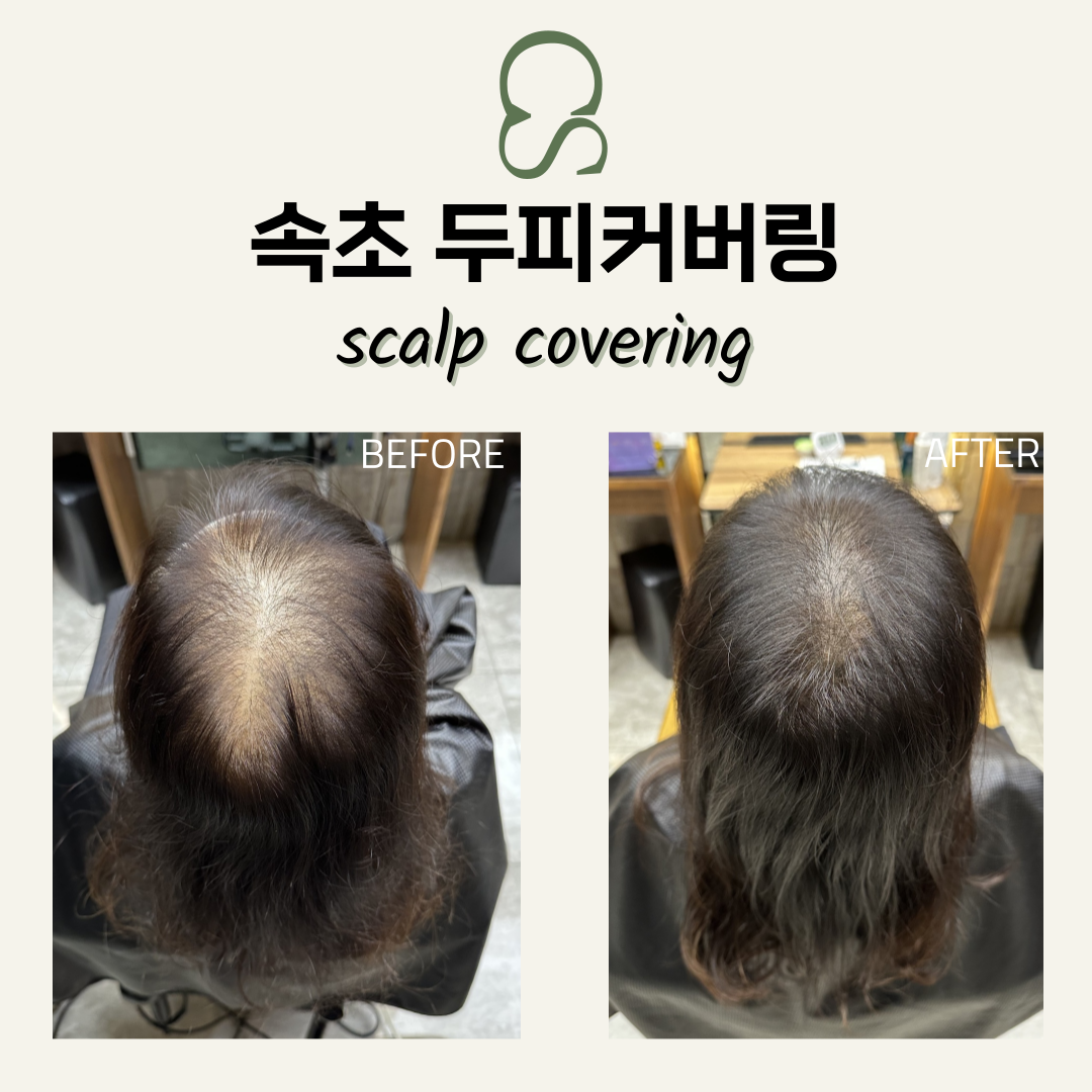 속초두피커버링