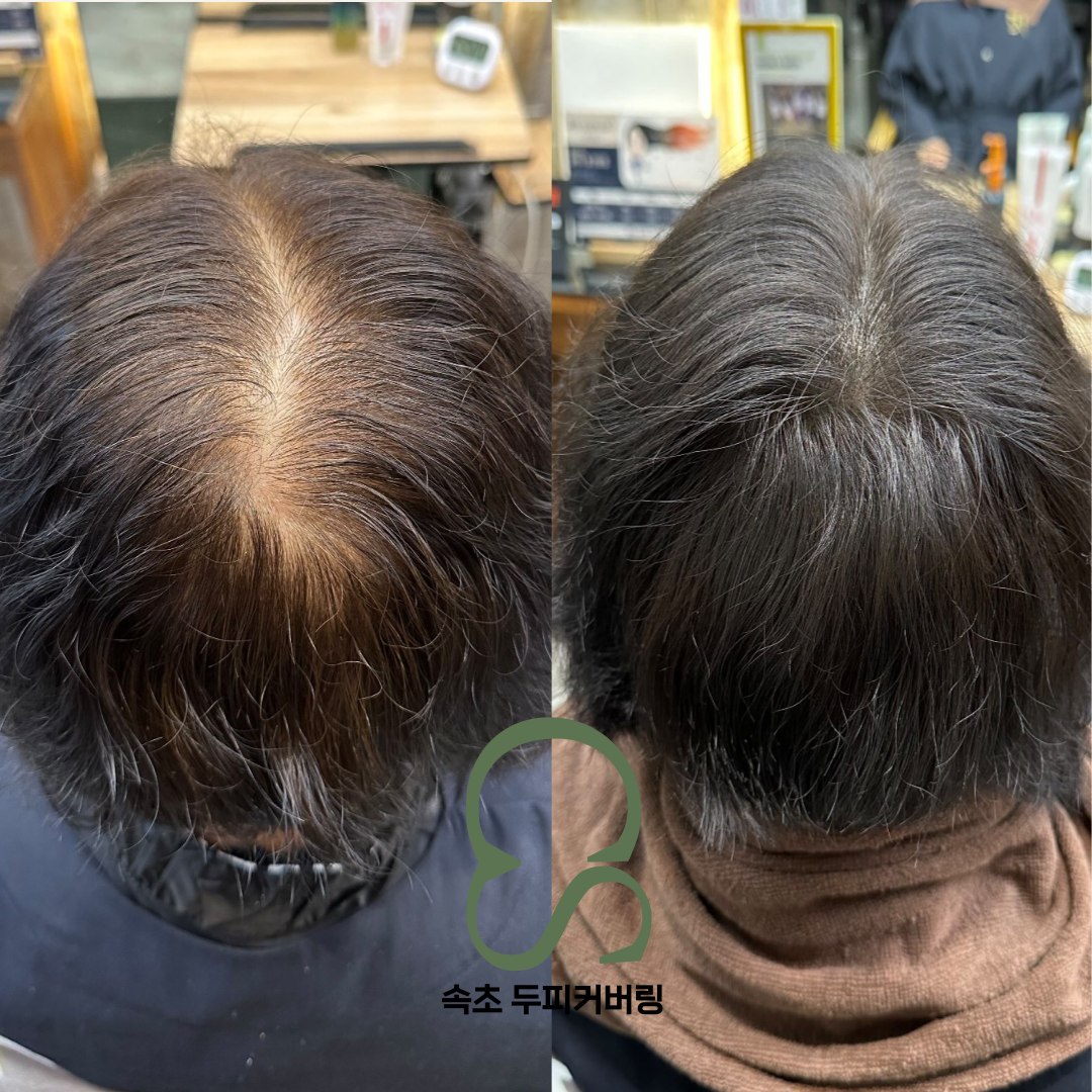 속초두피커버링