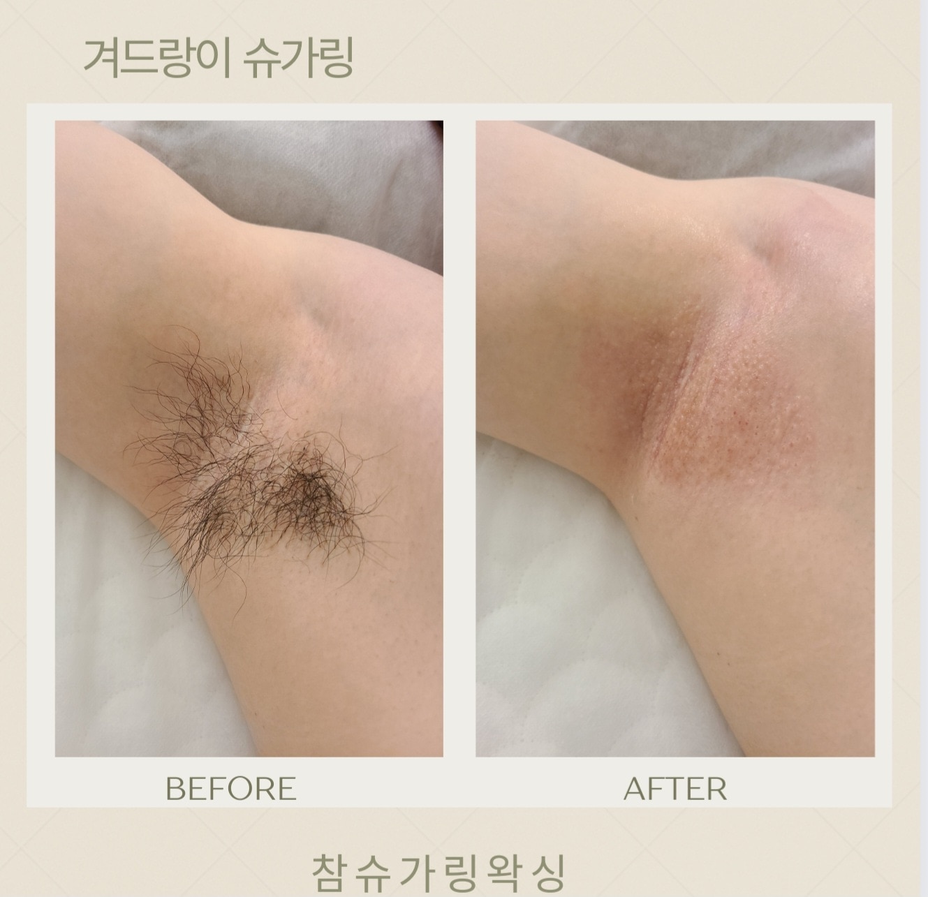 참슈가링왁싱