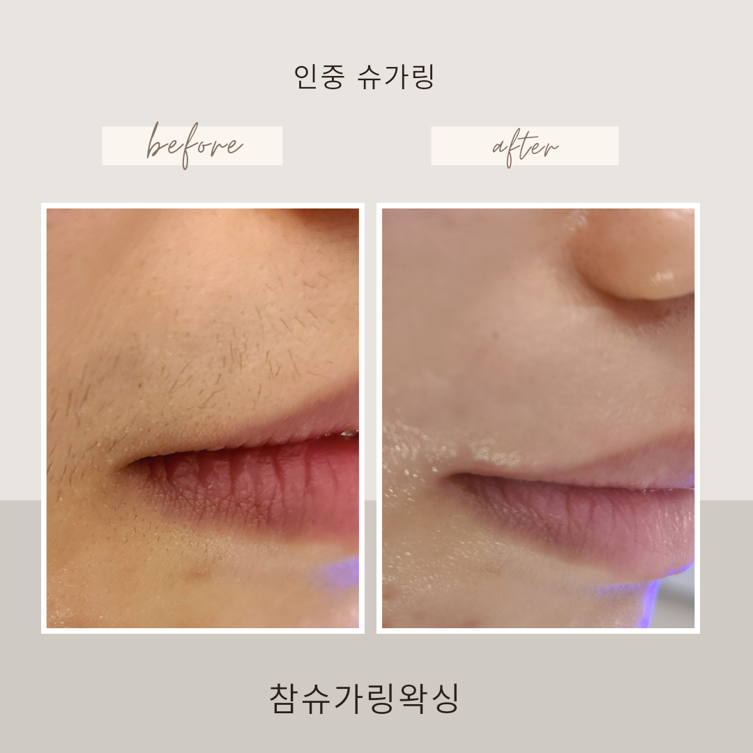 참슈가링왁싱