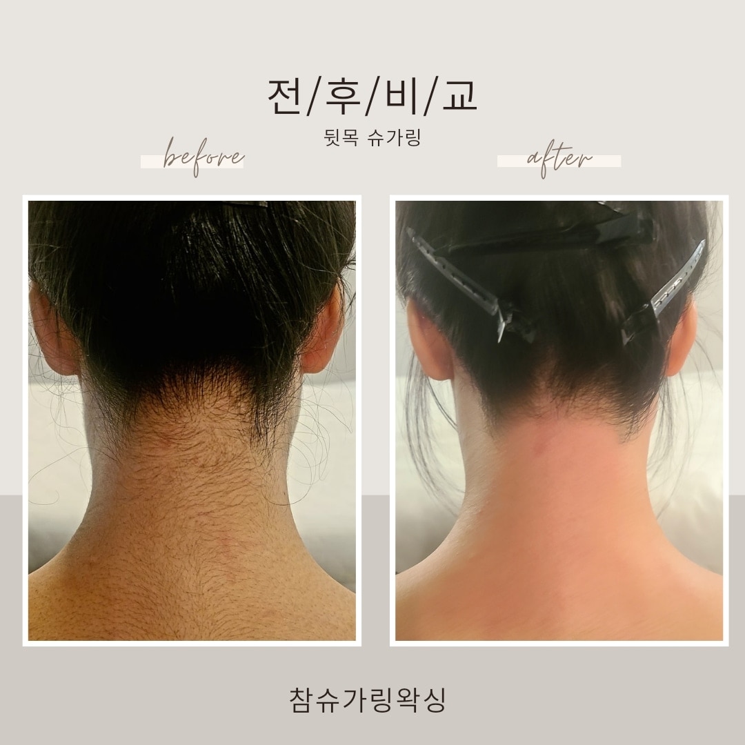 참슈가링왁싱