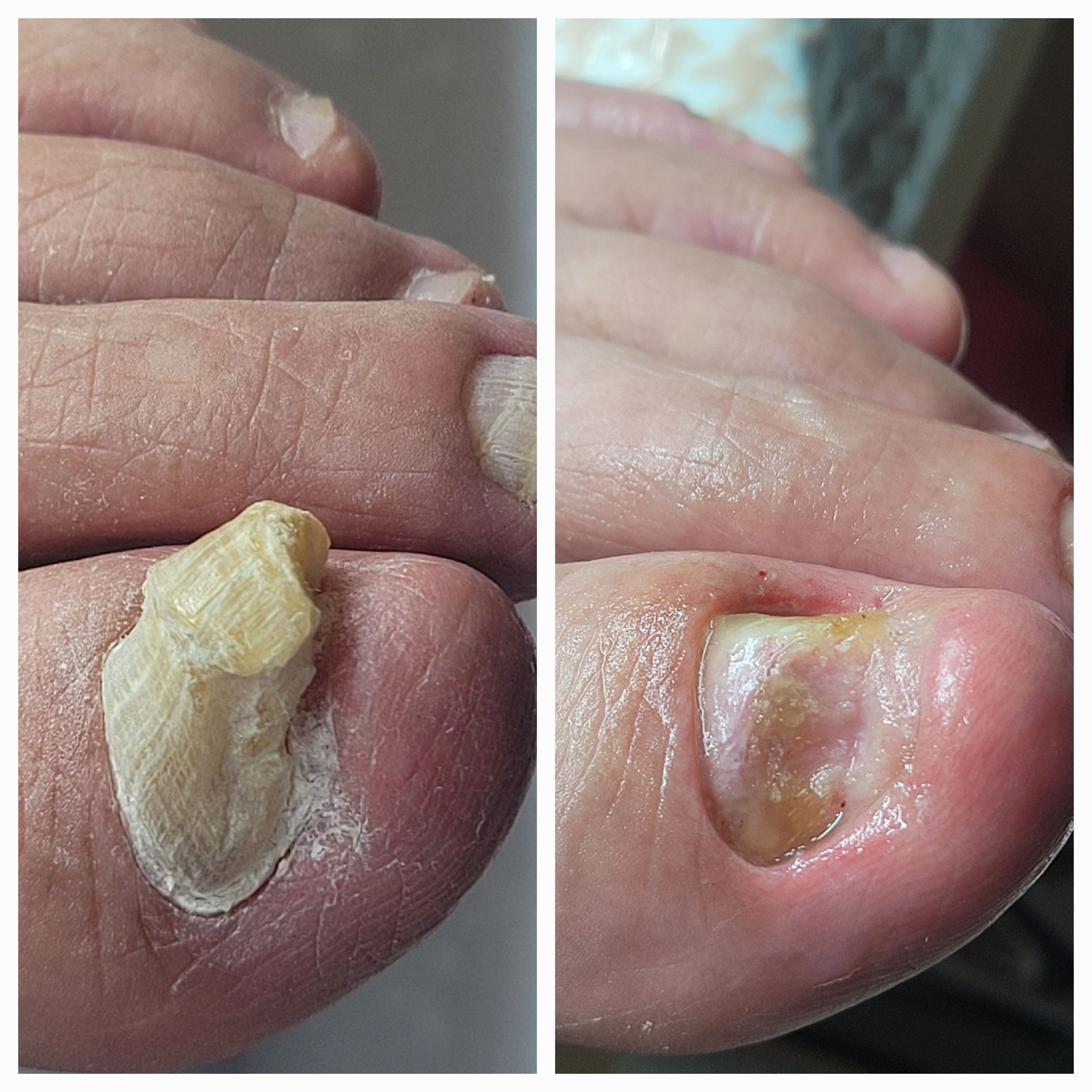 네이처뷰티 내성발톱&무좀발톱&발각질&문제성발&네일아트 대표 이미지