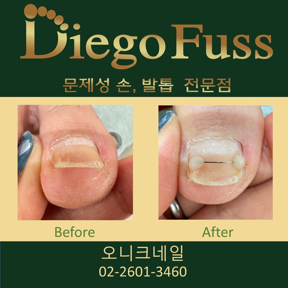 오니크네일.디에고푸스화곡점.문제성.내성발톱.발각질전문