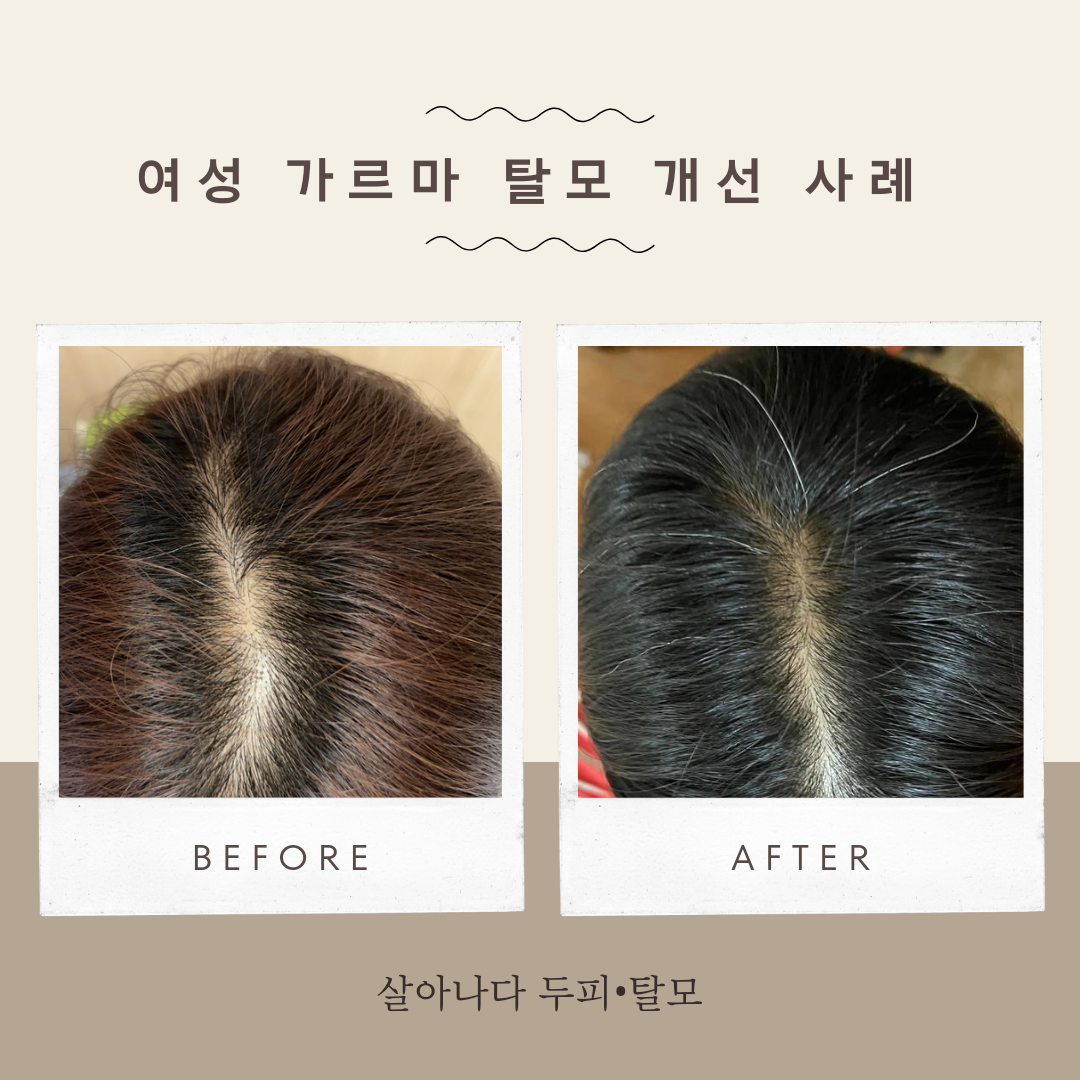 살아나다 두피탈모 부산해운대점