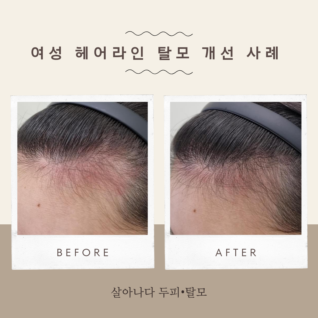 살아나다 두피탈모 부산해운대점