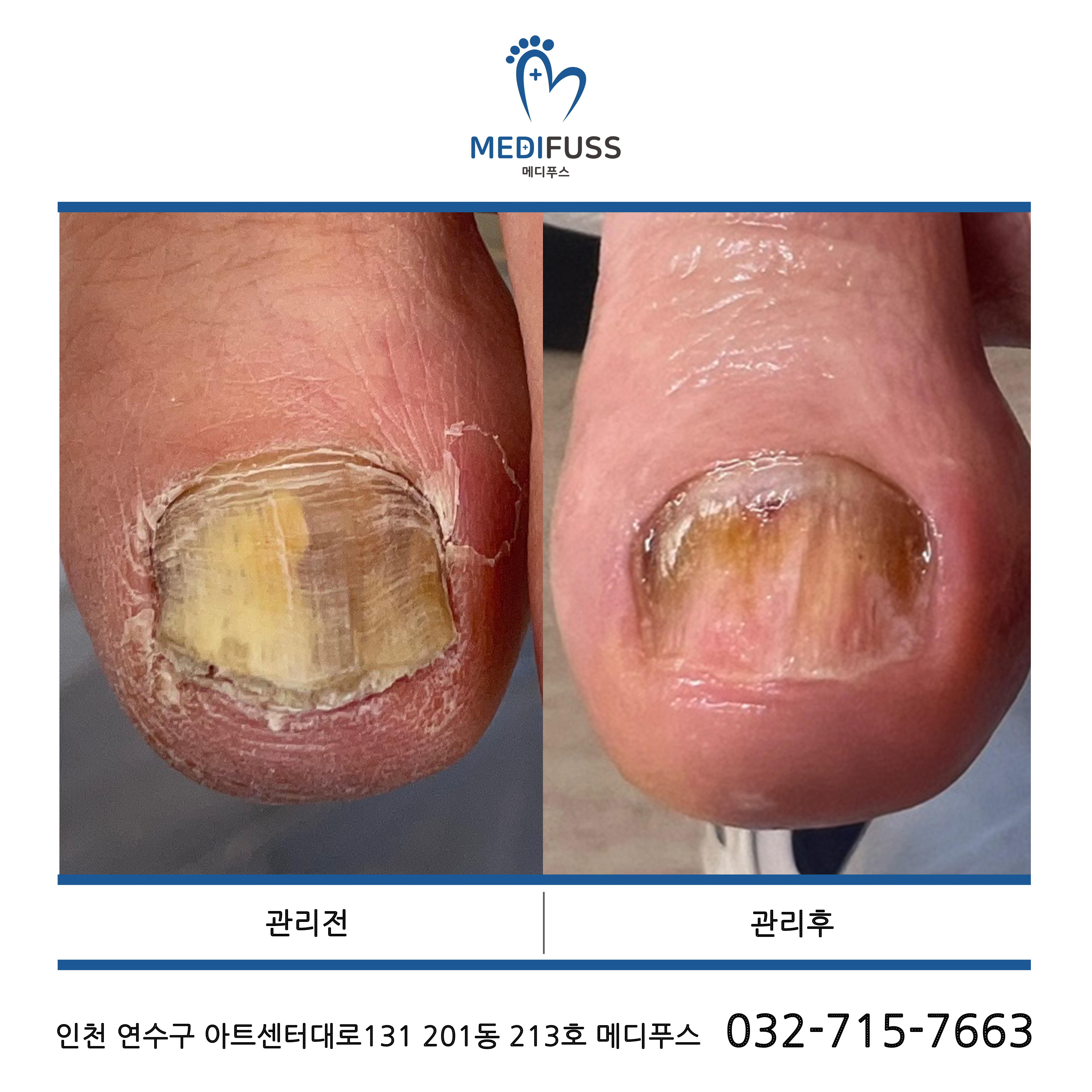 문제성발관리센터 메디푸스 내성발톱 무좀 각질 문제성발톱
