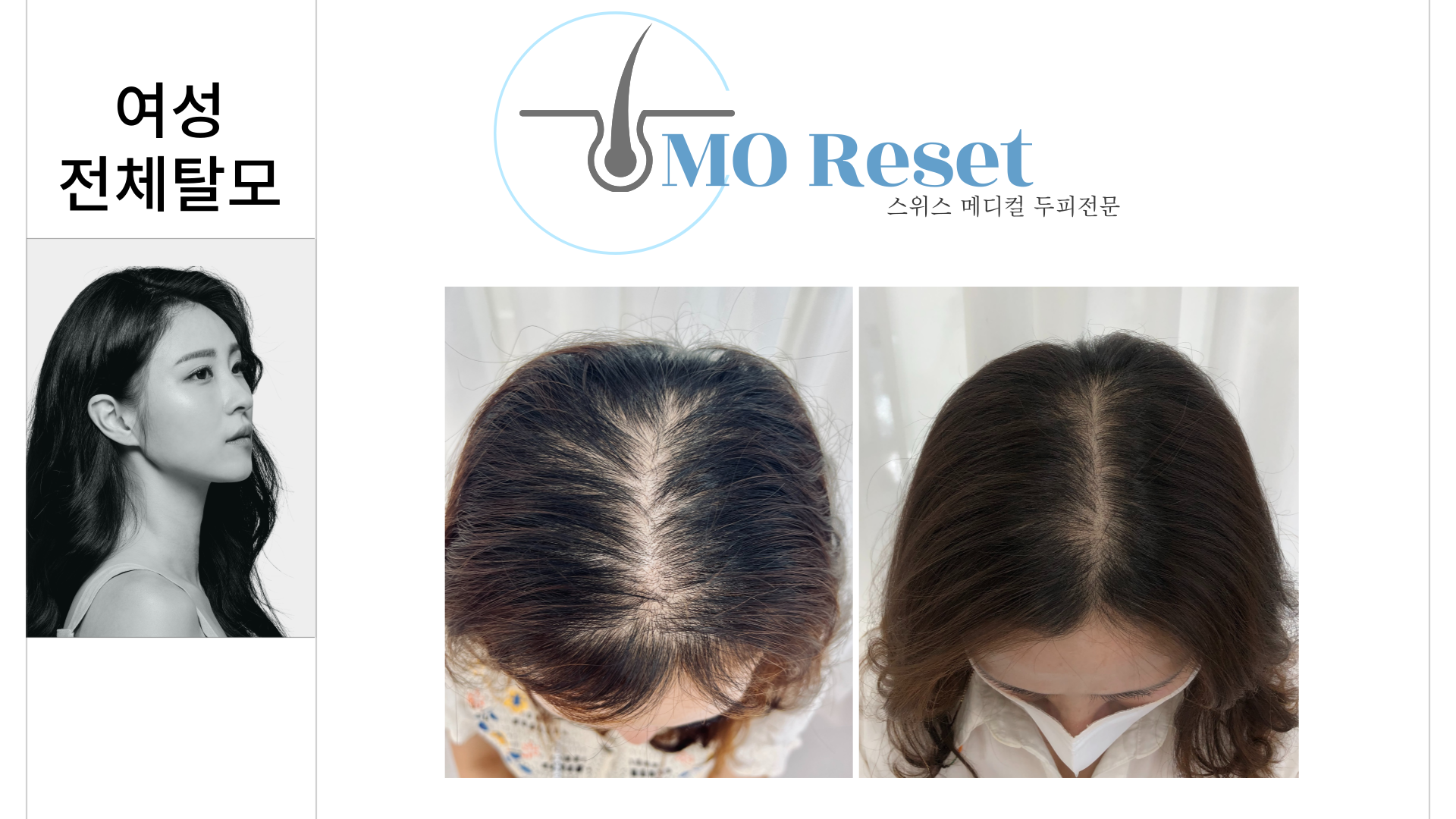 모리셋두피재생센터 당진점 대표 이미지