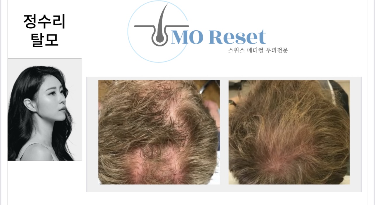 모리셋두피재생센터 당진점 대표 이미지