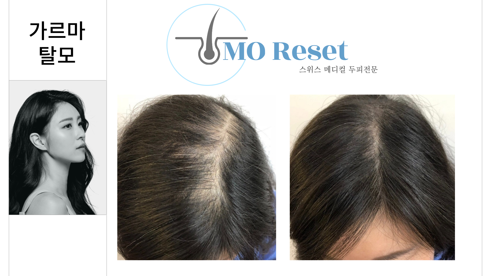 모리셋두피재생센터 당진점 대표 이미지