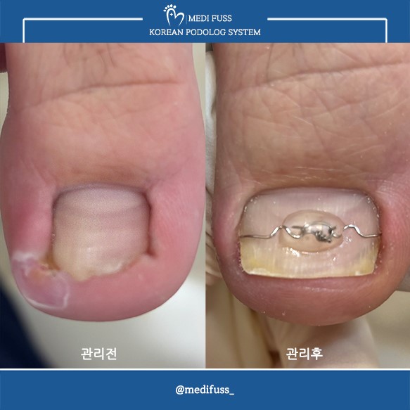 문제성발관리센터 메디푸스 내성발톱 무좀 각질 문제성발톱