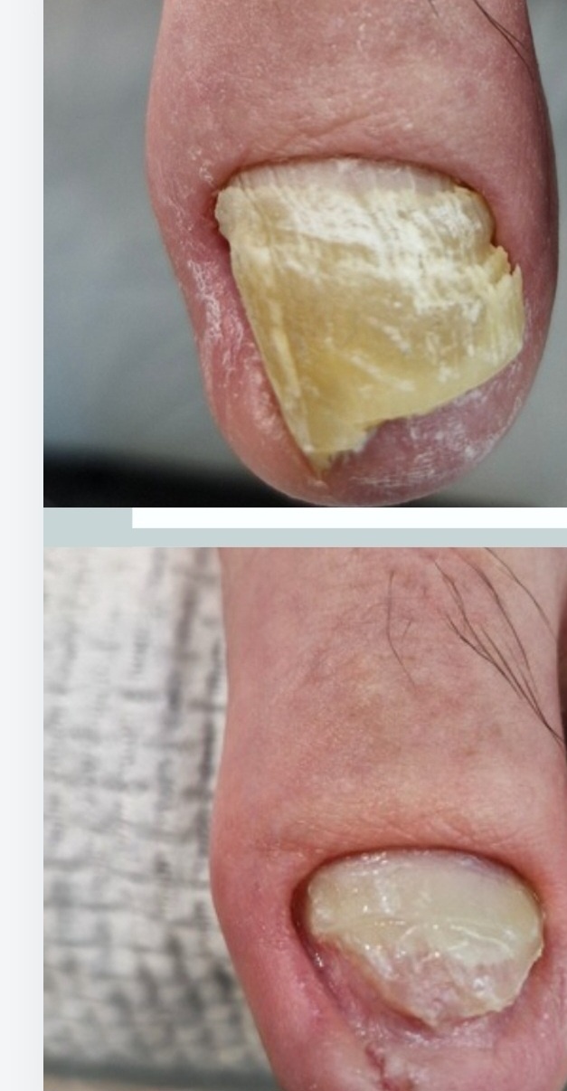 메디컬풋케어 발톱관리 발각질 대표 이미지