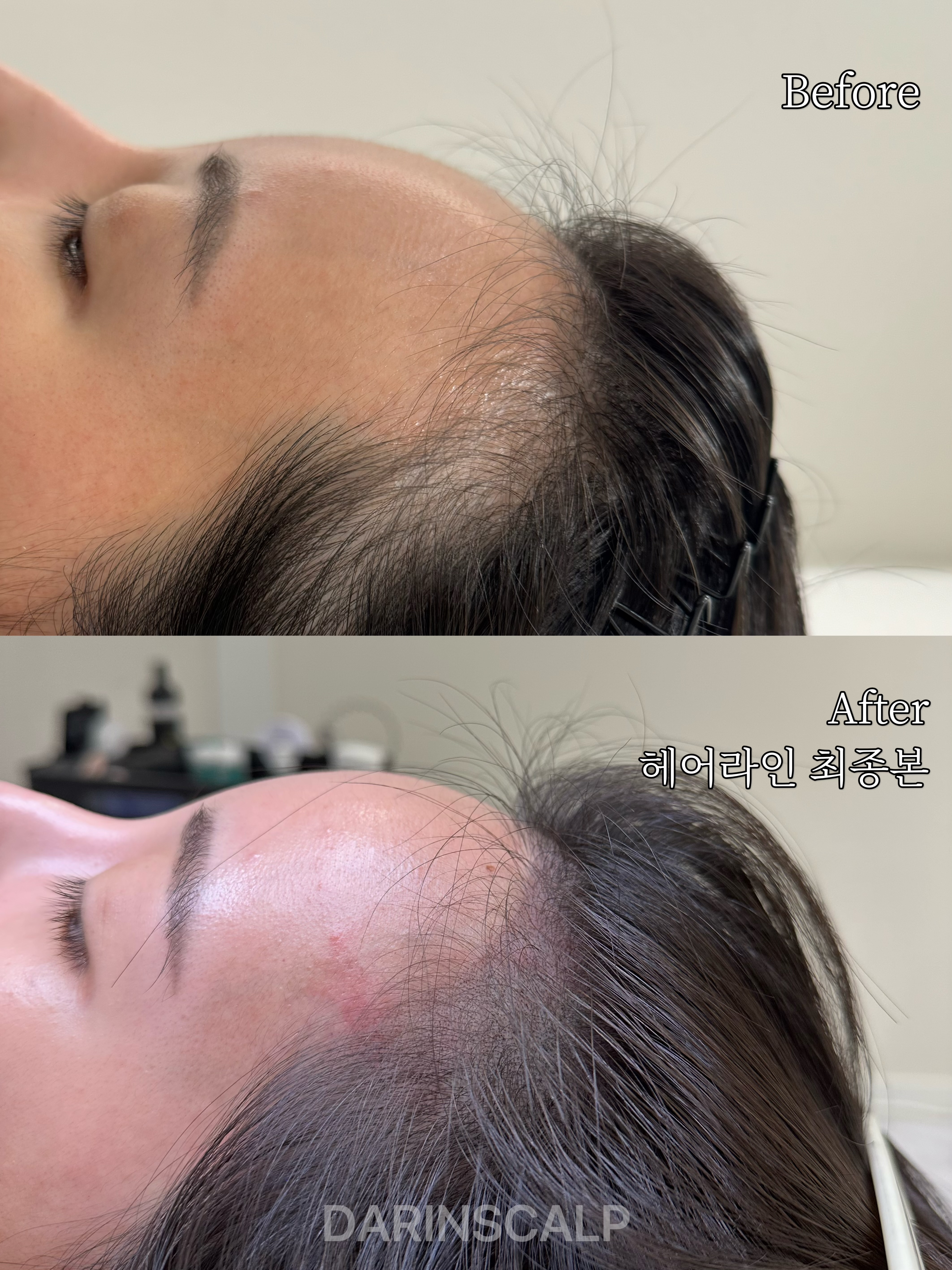 다린스칼프