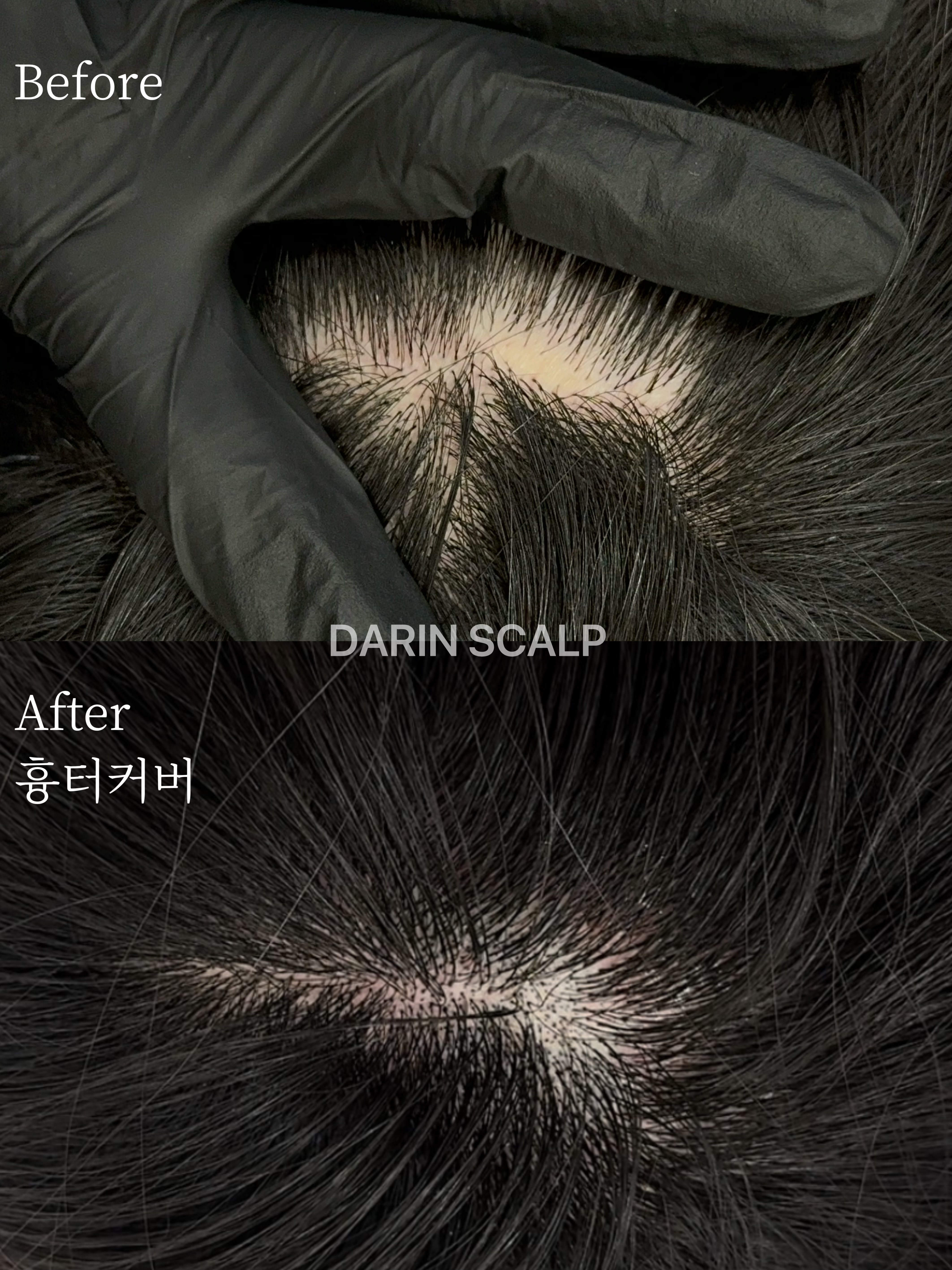 다린스칼프