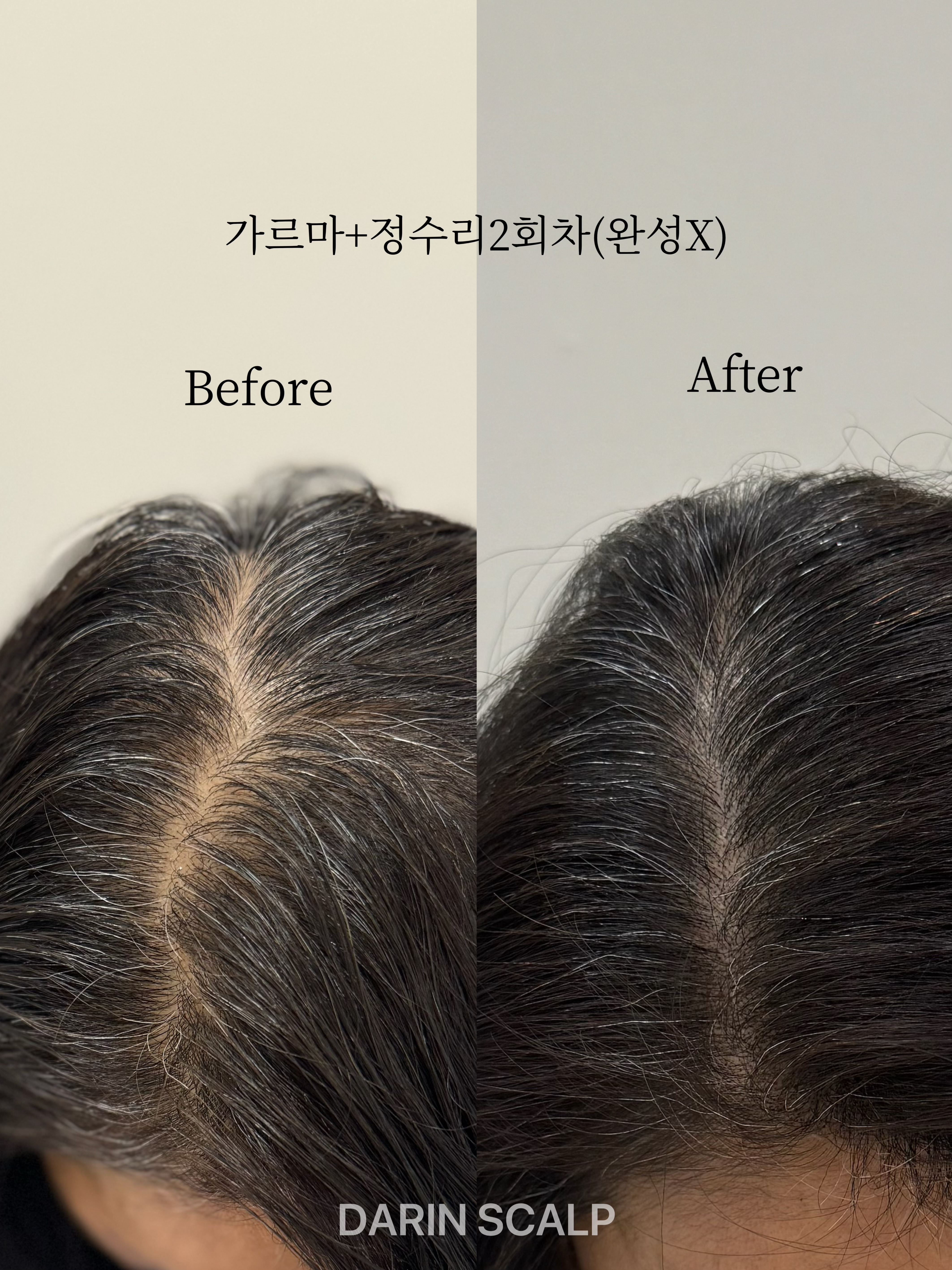 다린스칼프
