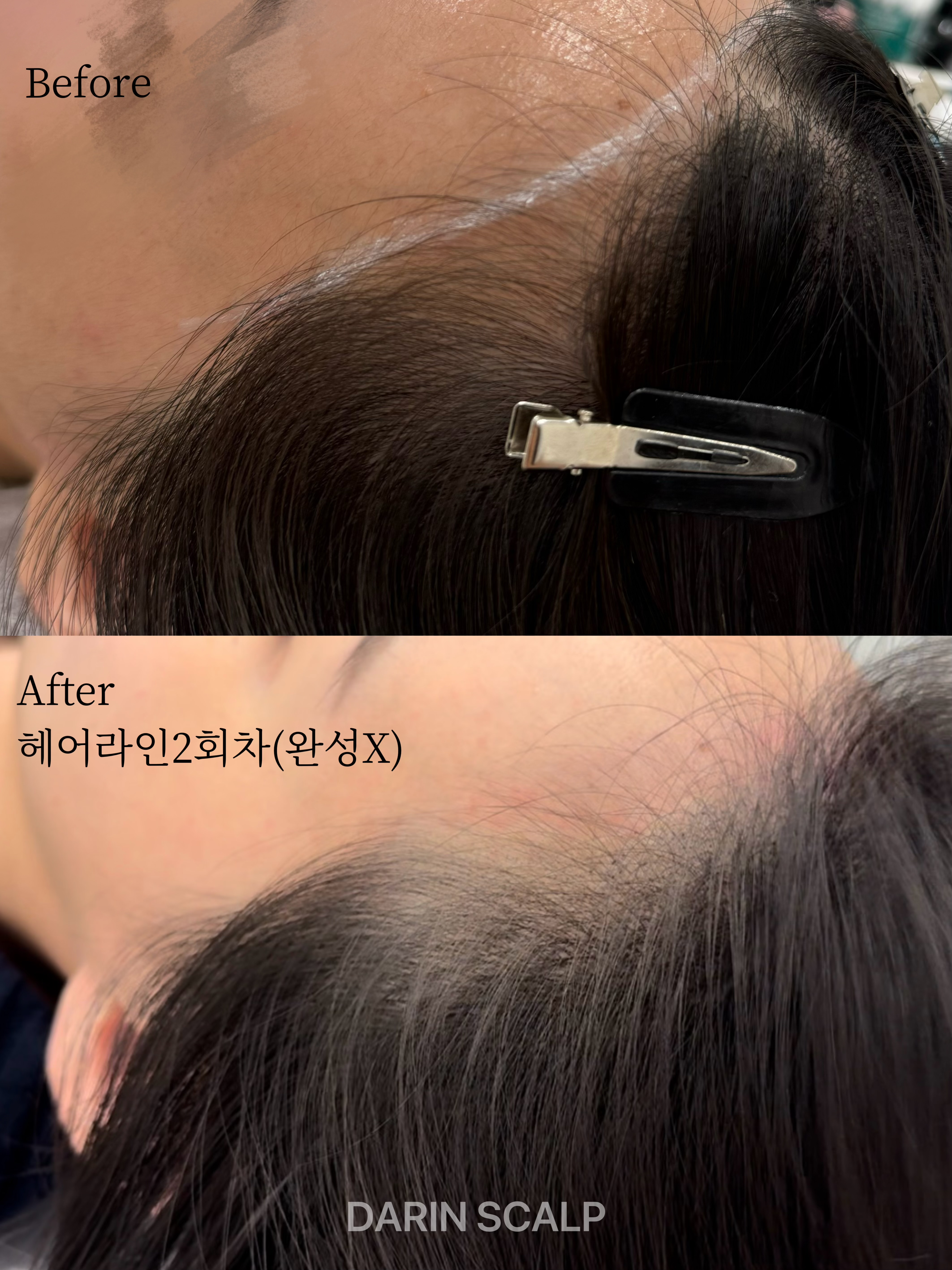 다린스칼프