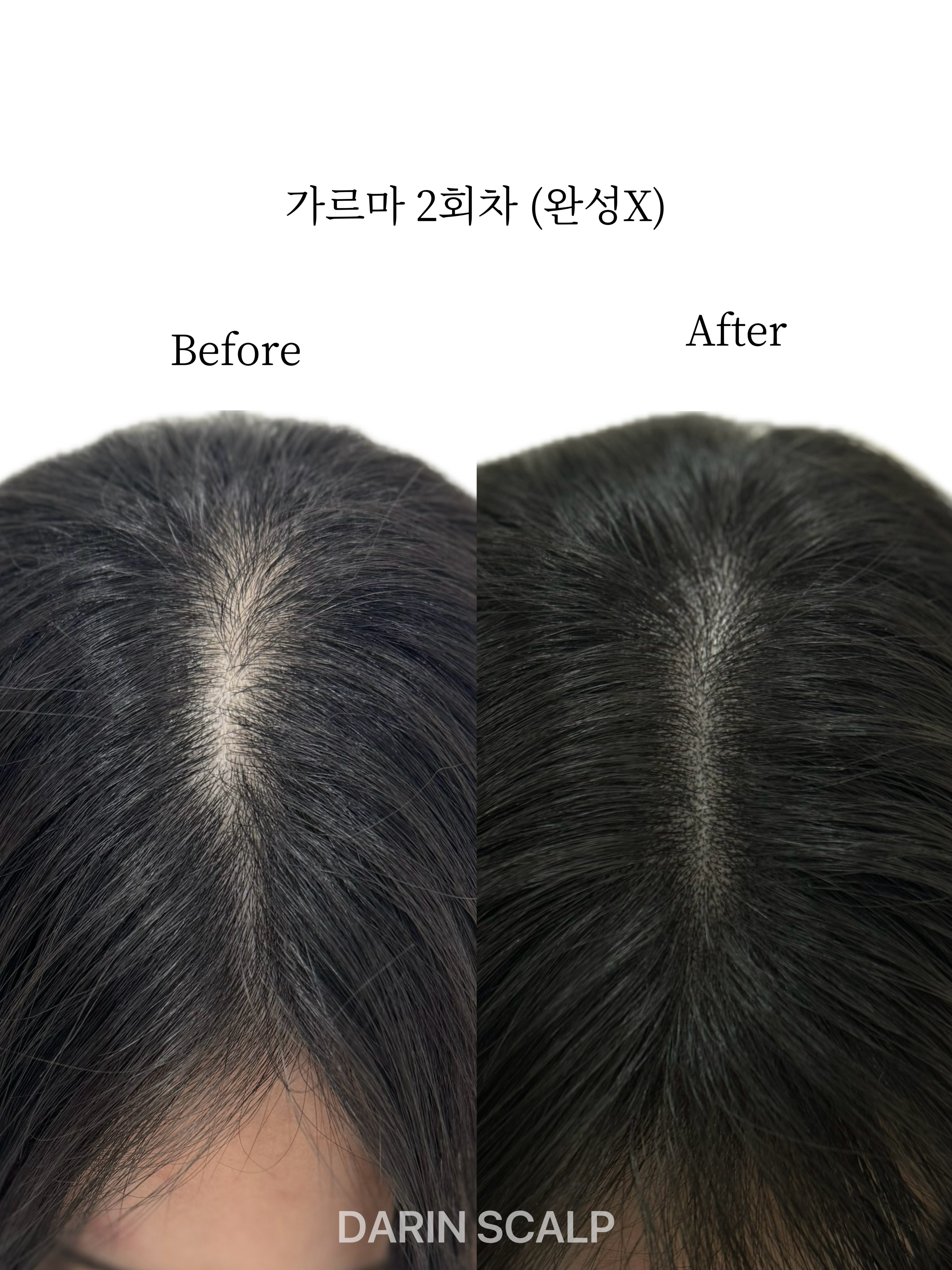 다린스칼프