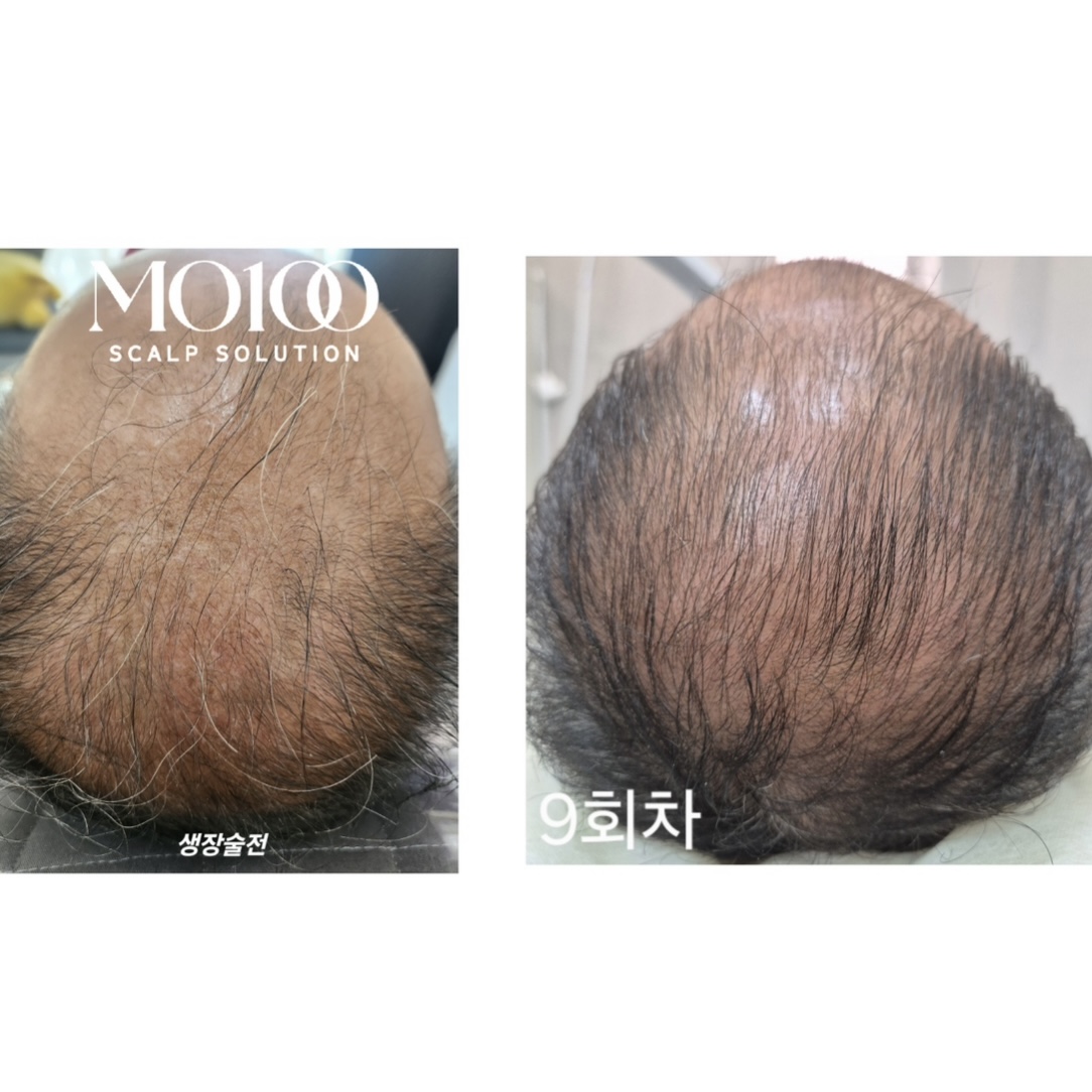 다예쁨뷰티xMO100인천 눈썹&입술 두피&탈모관리