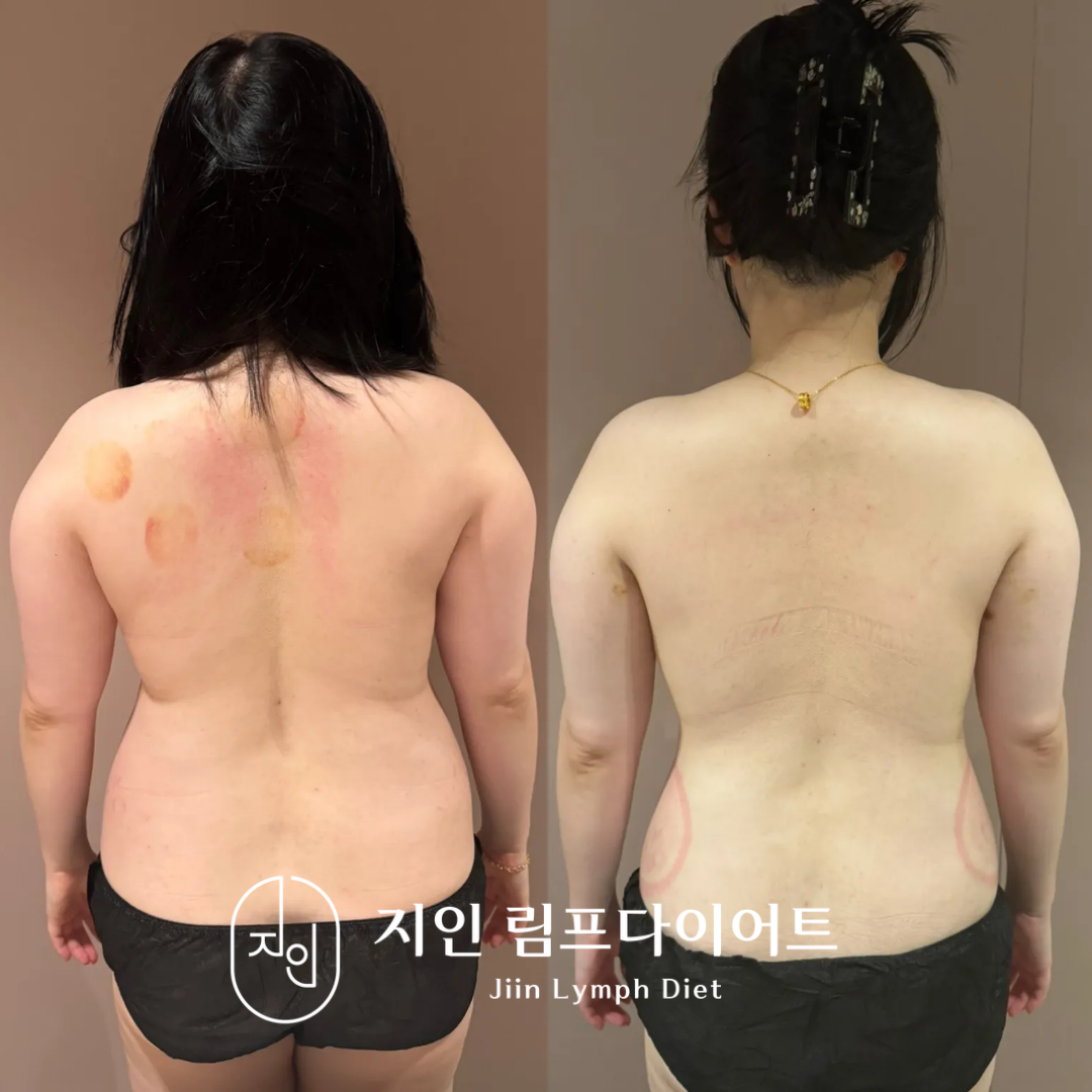 지인림프다이어트 photo 3